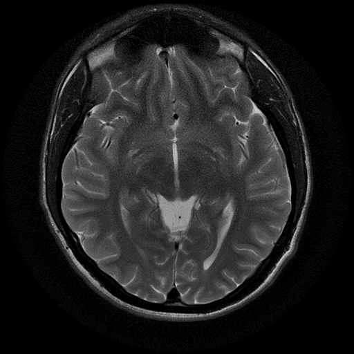 File:Azygos anterior cerebral artery (Radiopaedia 17059-16756 Axial T2 14).jpg