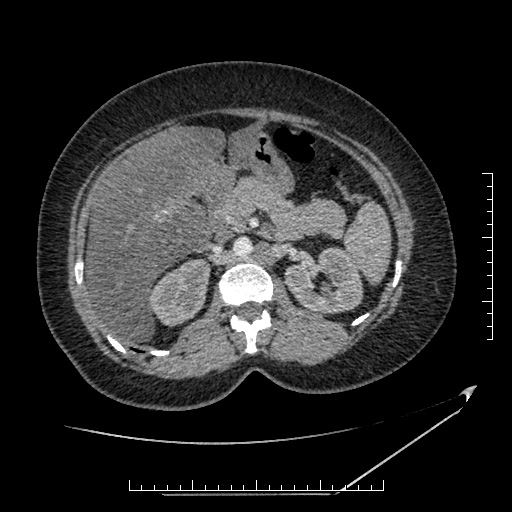 File:Azygos continuation of the IVC (Radiopaedia 40416-42965 A 29).jpg