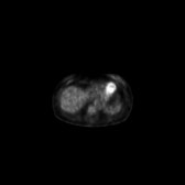 B-cell lymphoma of the mesentery (Radiopaedia 65743-74868 18F-FDG PET-CT 180).jpg