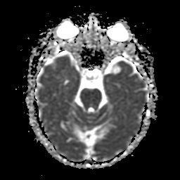 File:Balo concentric sclerosis (Radiopaedia 53875-59982 Axial ADC 9).jpg
