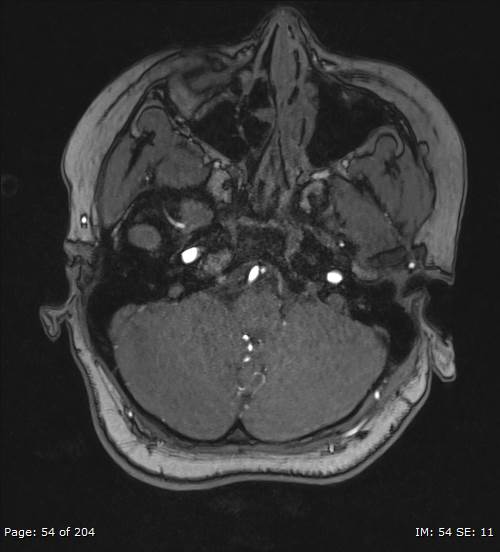 Balo concentric sclerosis (Radiopaedia 61637-69636 Axial MRA 54).jpg