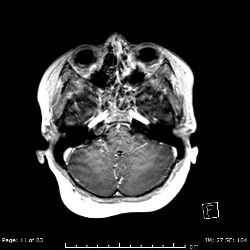 Balo concentric sclerosis (Radiopaedia 61637-69636 Axial T1 C+ 11).jpg