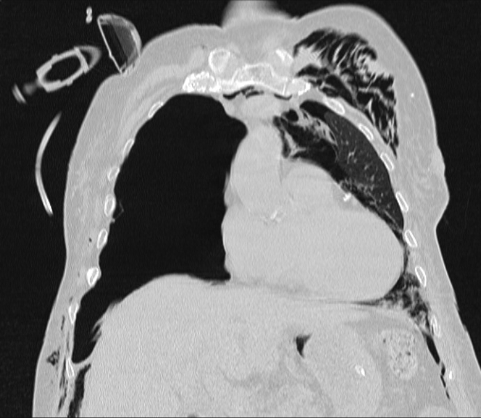 Barotrauma due to mechanical ventilation (Radiopaedia 28079-28336 Coronal lung window 36).jpg