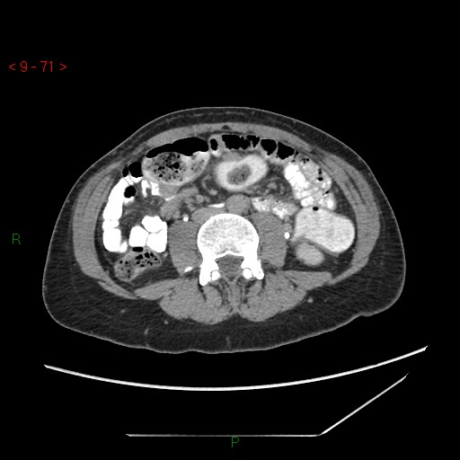 File:Bartholin gland cyst (Radiopaedia 54904-61181 Axial C+ delayed 18).jpg