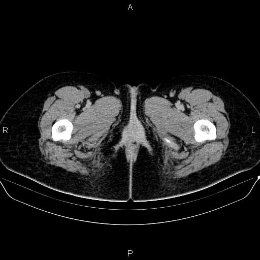 Bartholin gland cyst (Radiopaedia 62635-70930 C 100).jpg