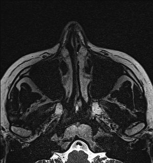 File:Basal cell carcinoma - nasal region (Radiopaedia 70292-80365 Axial Gradient Echo 15).jpg