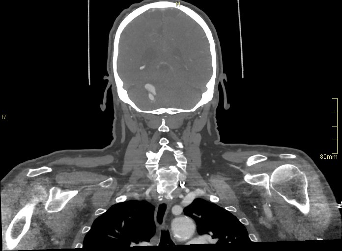 Basilar artery aneurysm (Radiopaedia 56261-62932 B 48).jpg