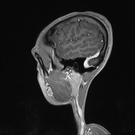 Basilar artery perforator aneurysm (Radiopaedia 82455-97733 G 126).jpg