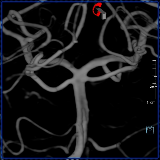 Basilar artery perforator aneurysm (Radiopaedia 82455-99524 3D Left VA 89).jpg