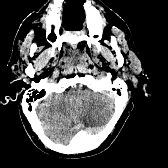 Basilar artery thrombosis (Radiopaedia 53351-59333 Axial non-contrast 28).jpg