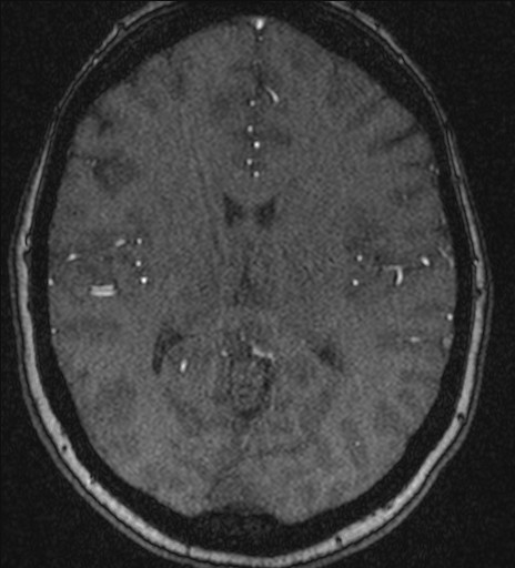 Basilar tip aneurysm (Radiopaedia 26504-26632 MRA 138).jpg