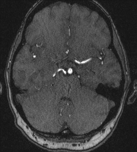 File:Basilar tip aneurysm (Radiopaedia 26504-26632 MRA 78).jpg