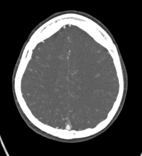File:Basilar tip aneurysm with coiling (Radiopaedia 53912-60086 A 112).jpg