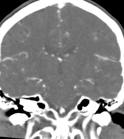 Basilar tip aneurysm with coiling (Radiopaedia 53912-60086 B 84).jpg