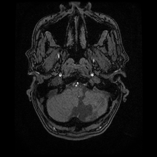 Basilar top and left middle cerebral artery aneurysm (Radiopaedia 61965-70031 Axial MRA 7).jpg