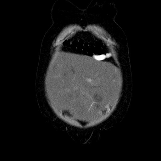 File:Benign spindle cell tumor - abdominopelvic (Radiopaedia 61300-69212 C 10).jpg
