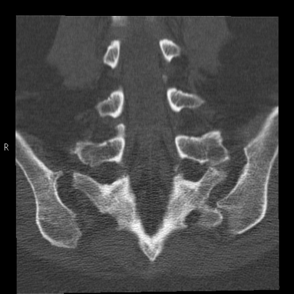 Bertolotti syndrome (Radiopaedia 24864-25128 Coronal bone window 31).jpg