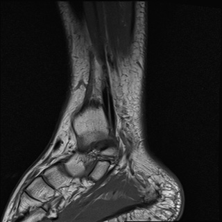 File:Bilateral Achilles tendon complete tear (Radiopaedia 81344-95051 Sagittal T1 18).jpg