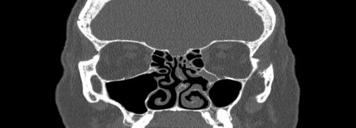 Bilateral Ectopic Infraorbital Nerves (Radiopaedia 49006-54084 Coronal bone window 33).jpg