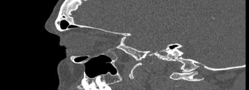 File:Bilateral Ectopic Infraorbital Nerves (Radiopaedia 49006-54084 Sagittal bone window 13).jpg