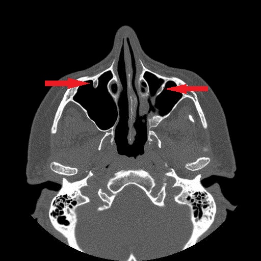 File:Bilateral Ectopic Infraorbital Nerves (Radiopaedia 49006-58325 Axial 4).jpg