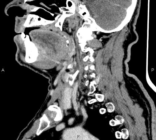 Bilateral Warthin tumors (Radiopaedia 84034-99263 D 49).jpg