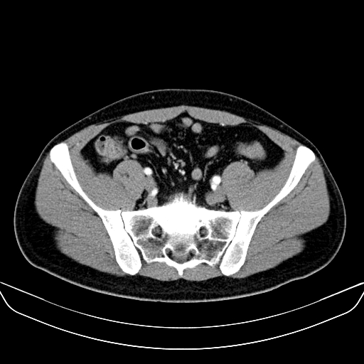 Bilateral accessory renal arteries with mild pelvi-ureteric junction (PUJ) obstruction (Radiopaedia 66357-75596 A 53).jpg