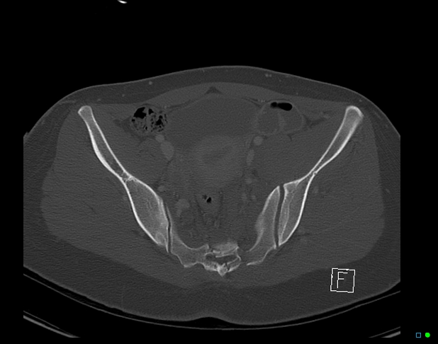 Bilateral acetabular fractures (Radiopaedia 79272-92308 Axial bone window 27).jpg