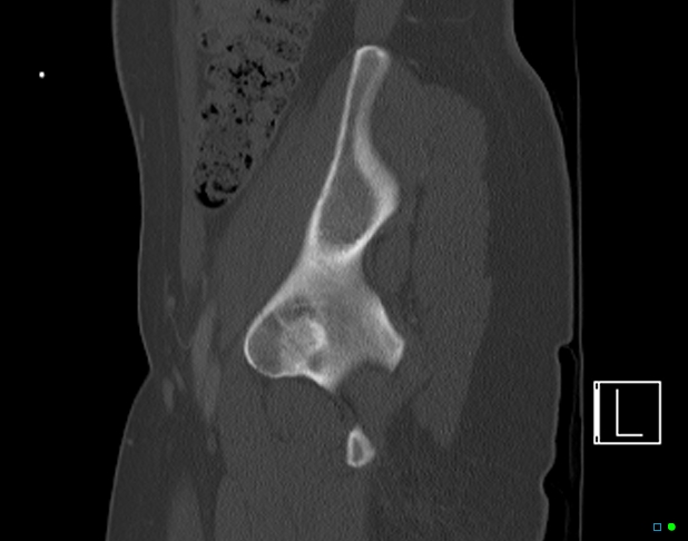 Bilateral acetabular fractures (Radiopaedia 79272-92308 Sagittal bone window 25).jpg