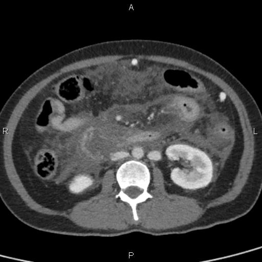 Bilateral adrenal gland hyperenhancement in pancreatitis (Radiopaedia 86642-102753 E 56).jpg