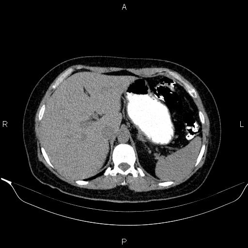 Bilateral adrenal myelolipoma (Radiopaedia 63058-71535 Axial non-contrast 37).jpg