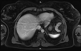 Bilateral adrenal myelolipoma (Radiopaedia 63058-71537 G 14).jpg