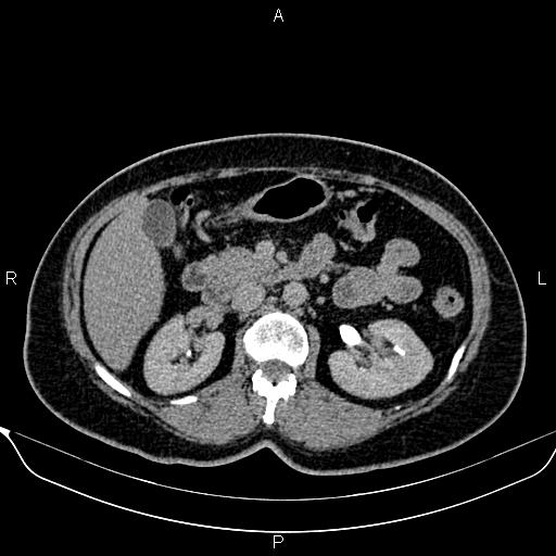 Bilateral benign adrenal adenomas (Radiopaedia 86912-103124 Axial C+ delayed 54).jpg