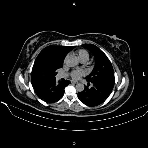 Bilateral benign adrenal adenomas (Radiopaedia 86912-103124 Axial non-contrast 1).jpg