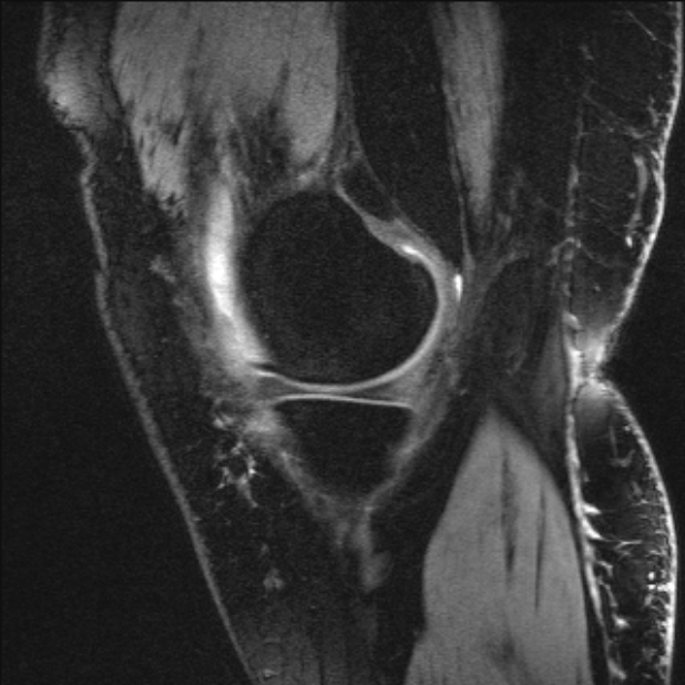 Bilateral focal pigmented villonodular synovitis (Radiopaedia 67643-77073 Sagittal T1 vibe 51).jpg