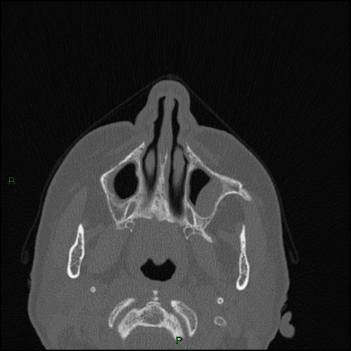 Bilateral frontal mucoceles (Radiopaedia 82352-96454 Axial bone window 221).jpg