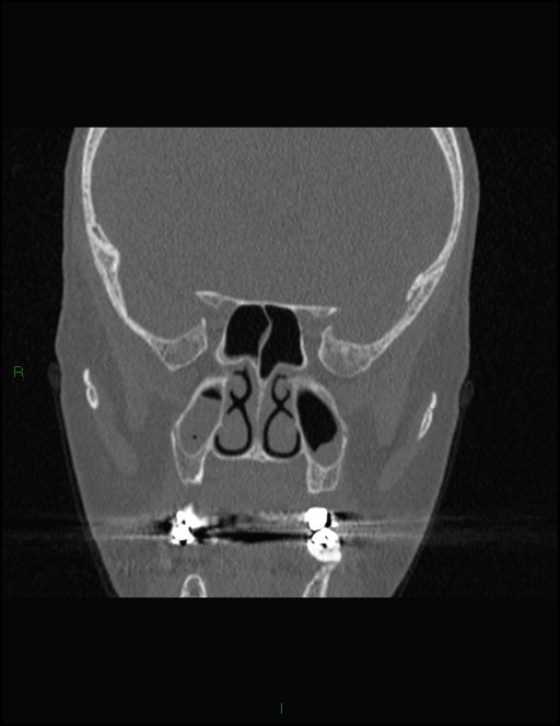 Bilateral frontal mucoceles (Radiopaedia 82352-96454 Coronal 186).jpg