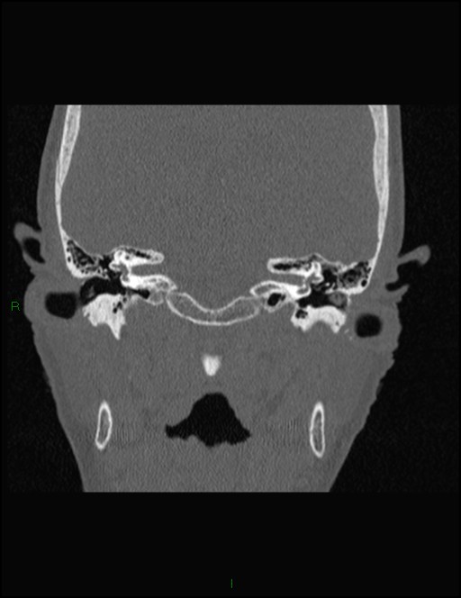 Bilateral frontal mucoceles (Radiopaedia 82352-96454 Coronal 304).jpg
