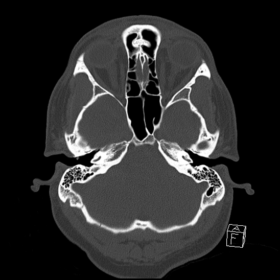 Bilateral occipital condyle fracture (type 2) (Radiopaedia 87675-104089 Axial bone window 28).jpg