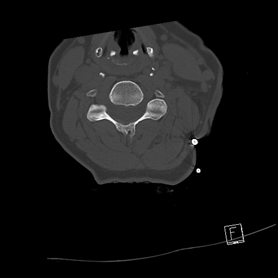 Bilateral occipital condyle fractures (type 3) (Radiopaedia 87672-104086 Axial bone window 43).jpg