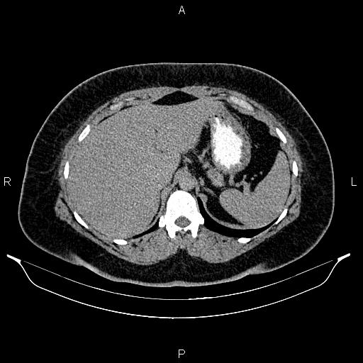 Bilateral ovarian dermoid cysts (Radiopaedia 85785-101603 Axial C+ delayed 11).jpg