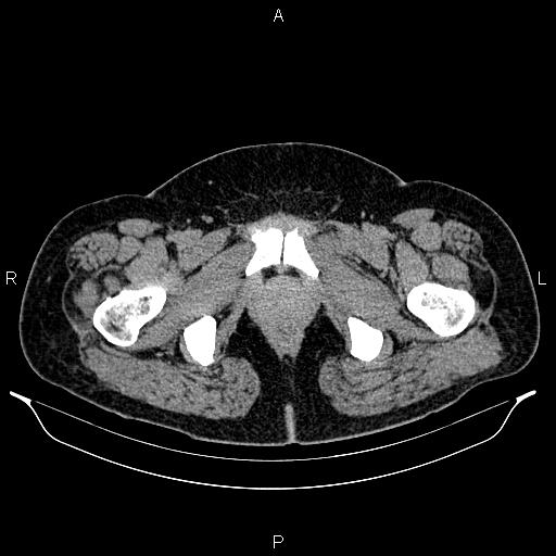 Bilateral ovarian dermoid cysts (Radiopaedia 85785-101603 Axial C+ delayed 91).jpg