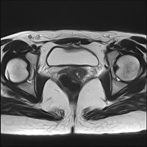 File:Bilateral ovarian endometriomas (Radiopaedia 87085-103347 Axial T2 16).jpg