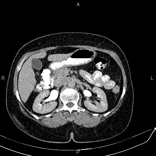 Bilateral ovarian serous cystadenocarcinoma (Radiopaedia 86062-101989 Axial C+ delayed 19).jpg