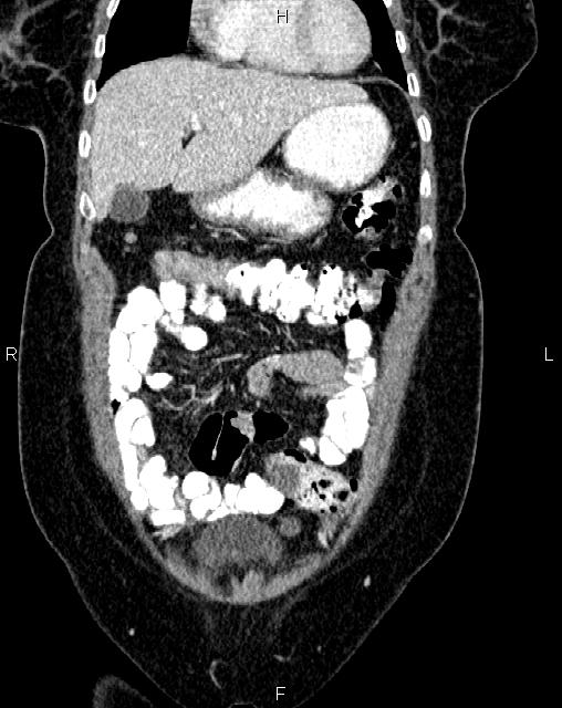 Bilateral ovarian serous cystadenocarcinoma (Radiopaedia 86062-101989 D 5).jpg