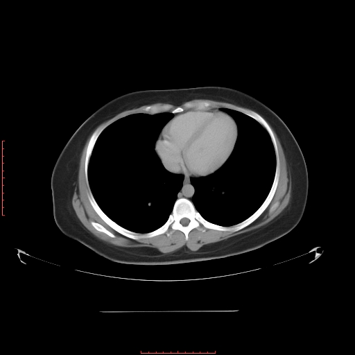 File:Bilateral ovarian serous cystadenocarcinoma with right ovarian torsion (Radiopaedia 32640-33611 A 2).jpg