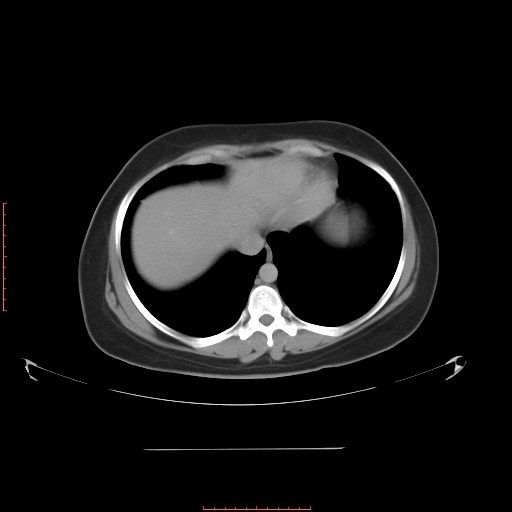 File:Bilateral ovarian serous cystadenocarcinoma with right ovarian torsion (Radiopaedia 32640-33611 A 5).jpg