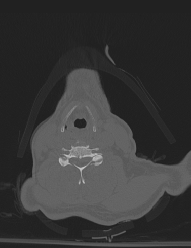 Bilateral perched facet joint (Radiopaedia 63149-71669 Axial bone window 36).jpg
