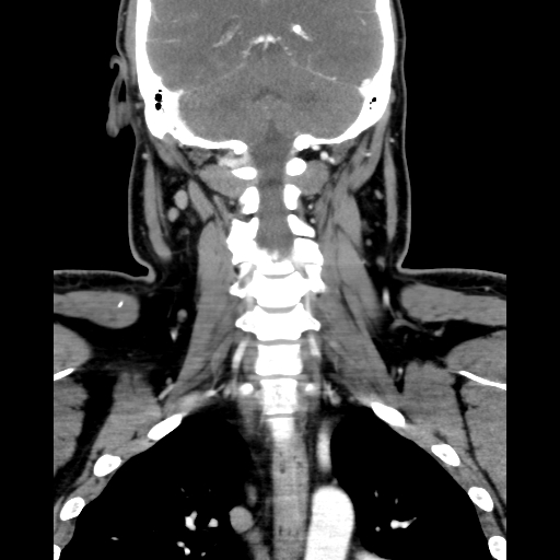 Bilateral peritonsillar abscess (Radiopaedia 85065-100610 Coronal 52).jpg
