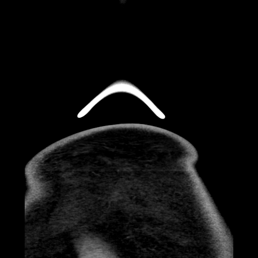 Bilateral peritonsillar abscess (Radiopaedia 85065-100610 Coronal 82).jpg